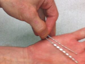 Spinal Cord Stimulator