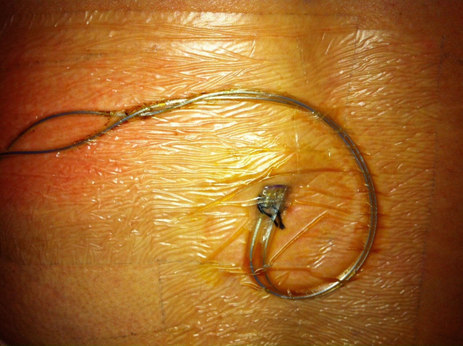 Spinal Cord Stimulator