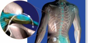 Dorsal Root Ganglion Stimulation