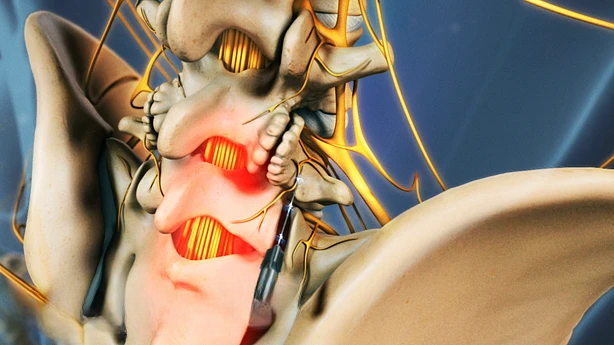 Radiofrequency Ablation