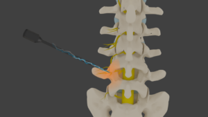 Radiofrequency Ablation
