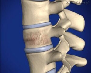 kyphoplasty