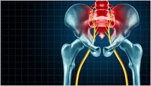 Sciatica