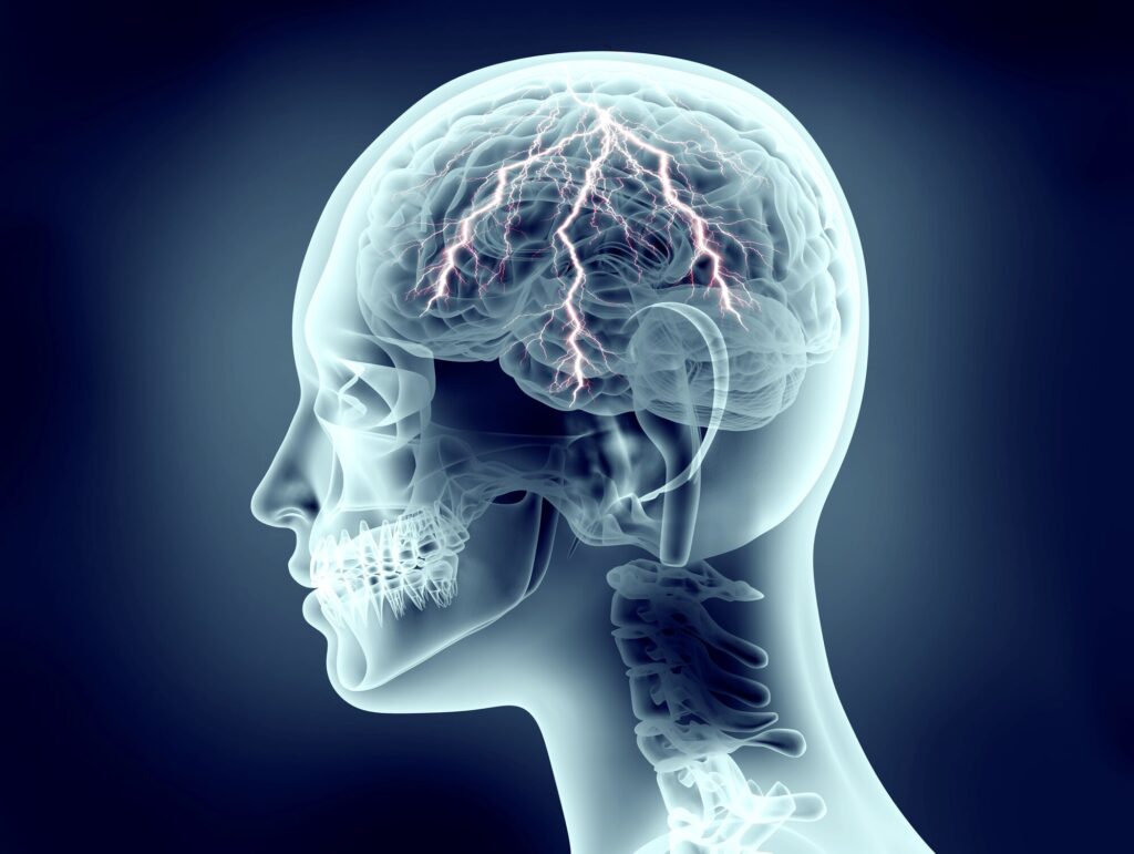 Neurostimulation Therapy