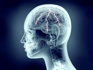 Neurostimulation Therapy