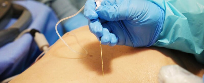 Nerve Blocks