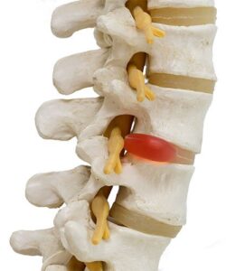 Herniated Discs