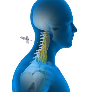 Nerve Blocks