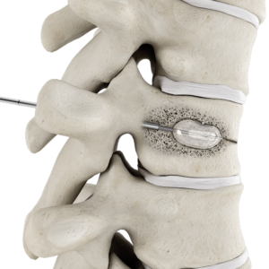 Kyphoplasty Treatment