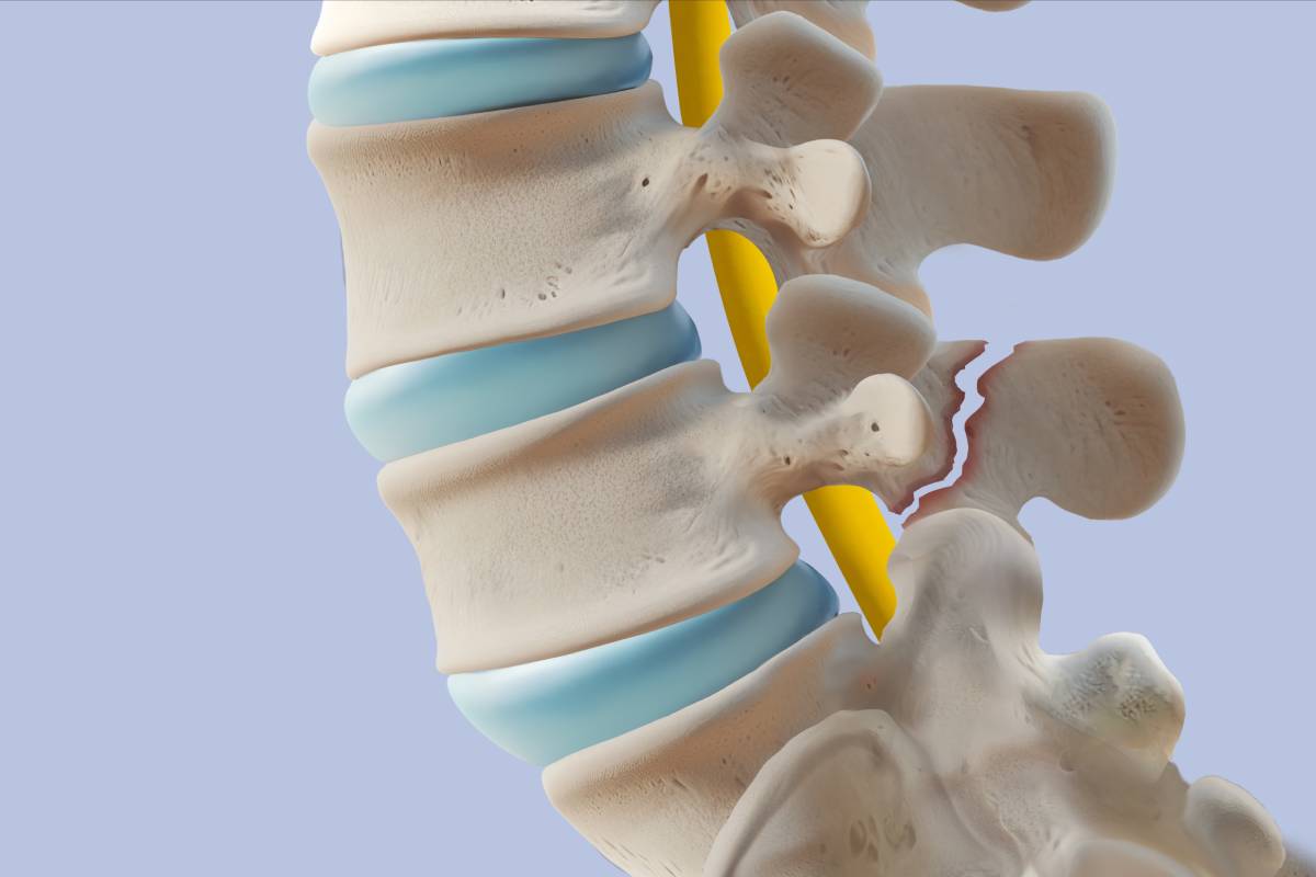 Kyphoplasty Specialist