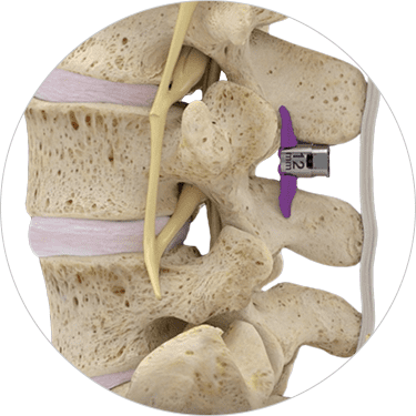 Superion Implants