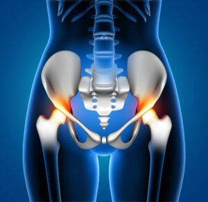 Sacroiliac Joint Fusion