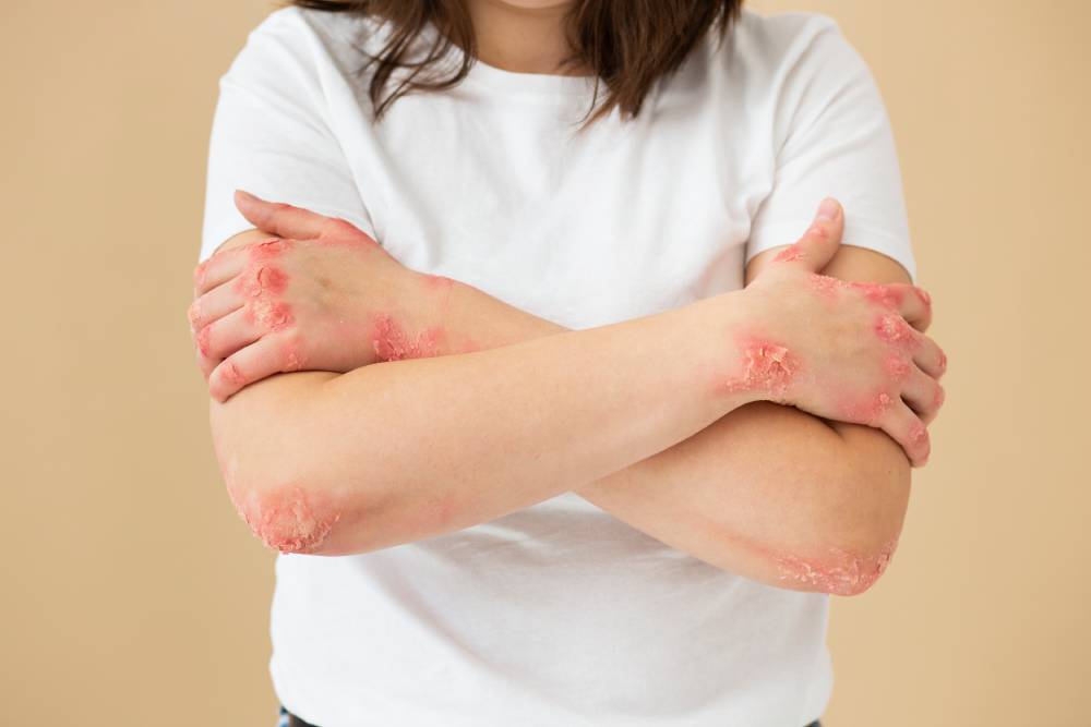Shingles Treatment
