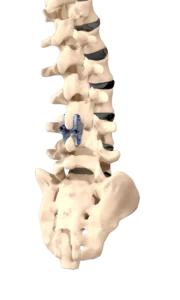 Inspan Procedure