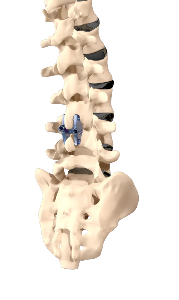 Inspan Procedure