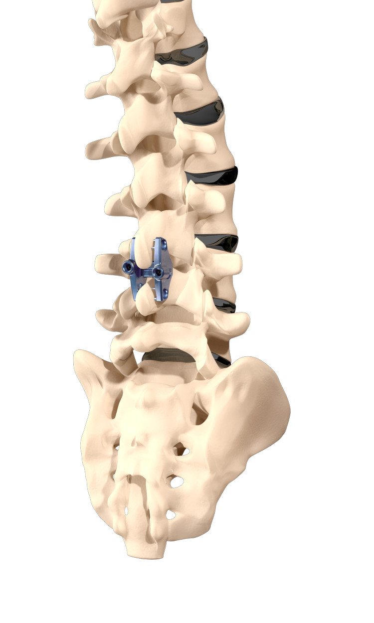 Inspan Procedure